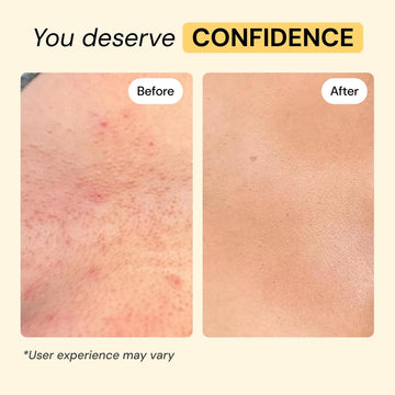 MyMagicHealer Universal Flare Care – Multi-Purpose Solution | Skin Flare-Ups - Hidradenitis Suppurativa, Folliculitis, Boils, Cysts