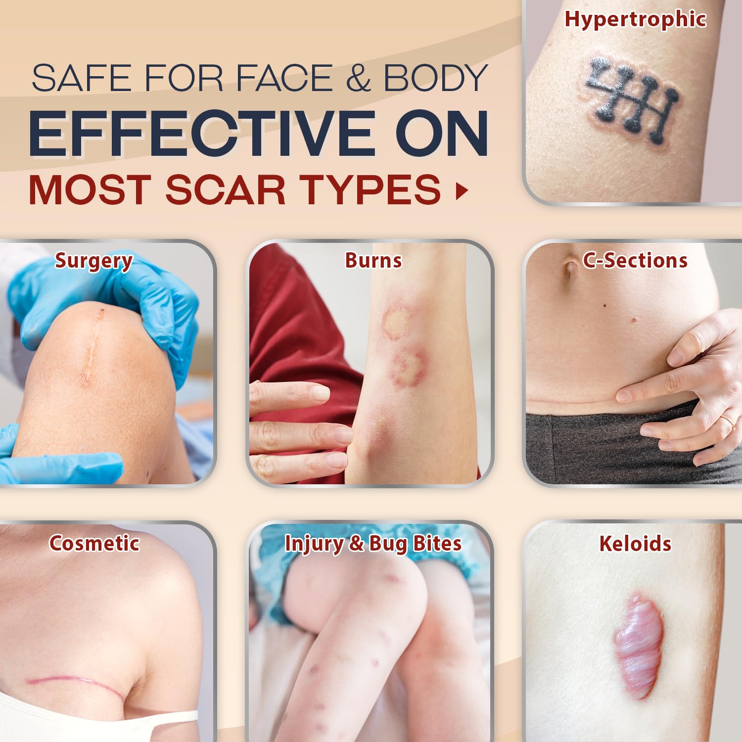Ebanel Silicone Scar Gel with Allantoin, Emu Oil, Vitamin E and Onion Extract, For Old & New Scars from Surgeries, C-Section, Injuries, Burns & More